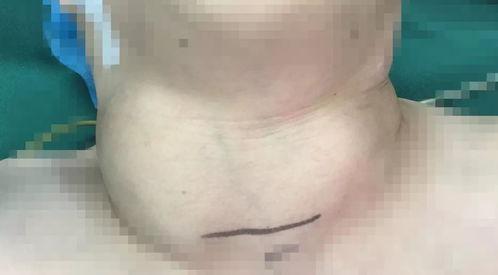 甲状腺手术过程视频,从麻醉到缝合，一窥手术奥秘